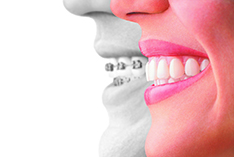 Trident Smiles Dental  Invisalign Aligners vs. Braces: Which is better for  your smile?